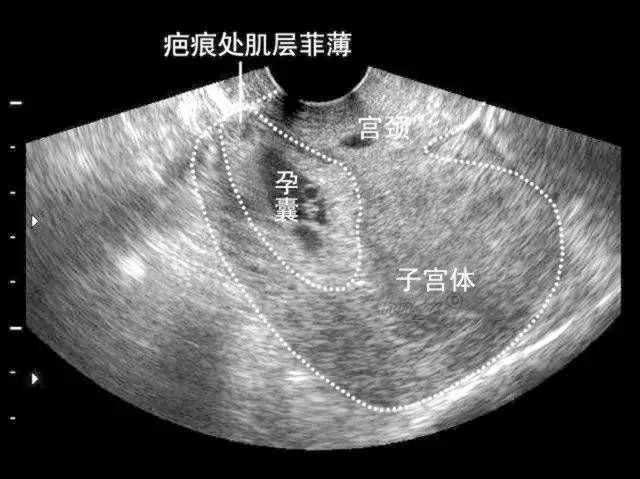 湘阴县卵巢功能衰退能借卵怀孕吗_做试管可以顺产吗？一定要剖腹产吗？